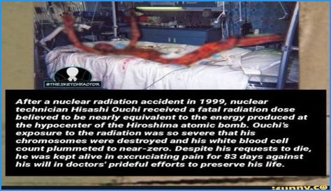 The Devastating Aftermath: Hisashi Ouchi's Autopsy Reveals Extent Of Radiation Damage